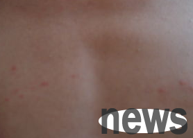 What should I do if a dog flea runs to a person?